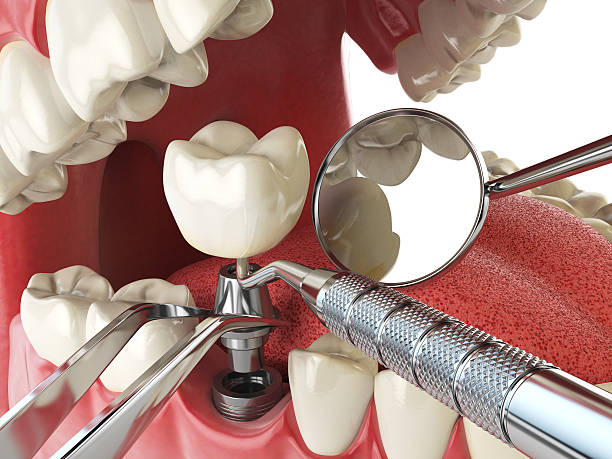 Best Broken or Cracked Tooth Emergency Dentist in Bartlett, TN